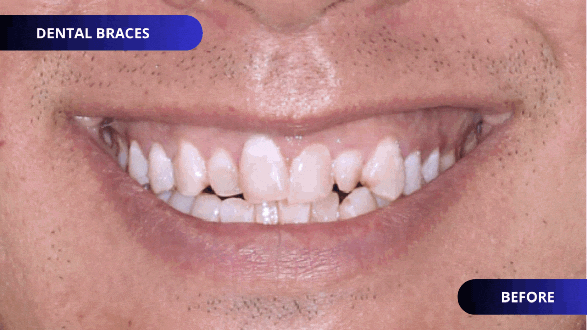 DENTAL BRACES 02 1
