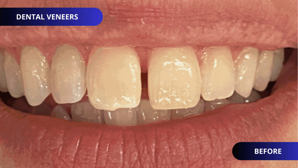 dental veneers