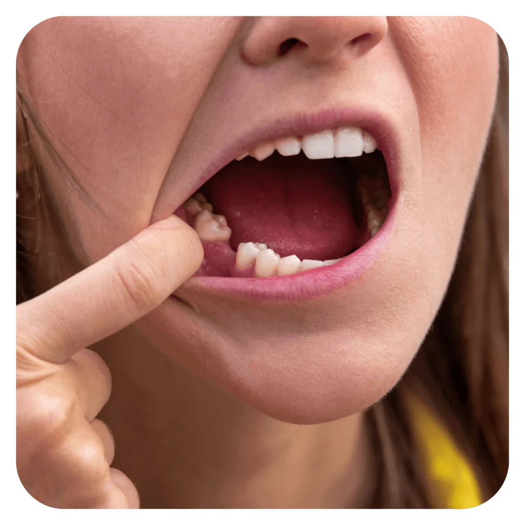 dental bridge sydney