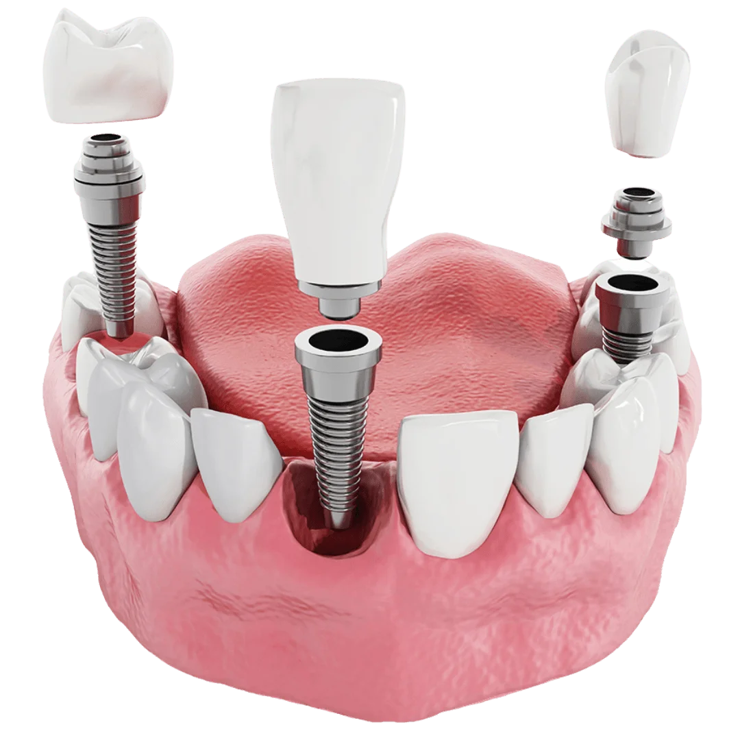 dental implants specialist